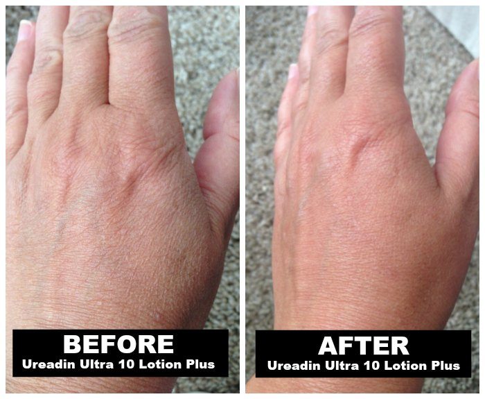 Before and after Ureadin Ultra 10 Lotion Plus